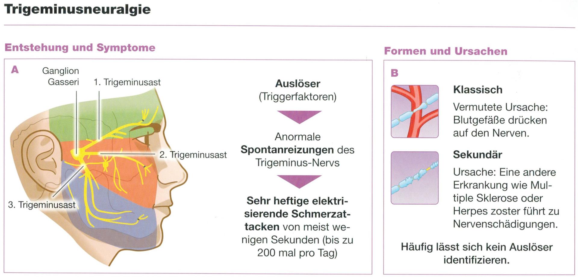 trigeminus neuralgie symptome - www.listaso.com.